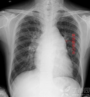 普大型心、梨形心、靴形心的片子究竟怎么看啊