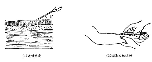 13.皮内注射的正确方法是