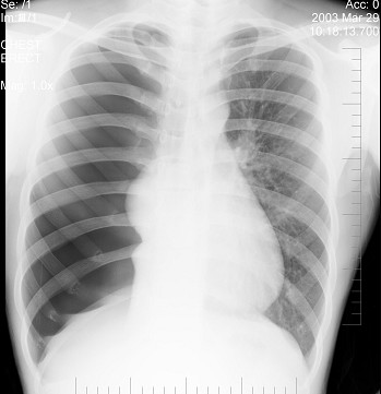 正常胸片 b.右侧肺气肿 c.纵隔肿瘤 d.右侧气胸 e.纵隔气