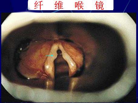 声带癌                            