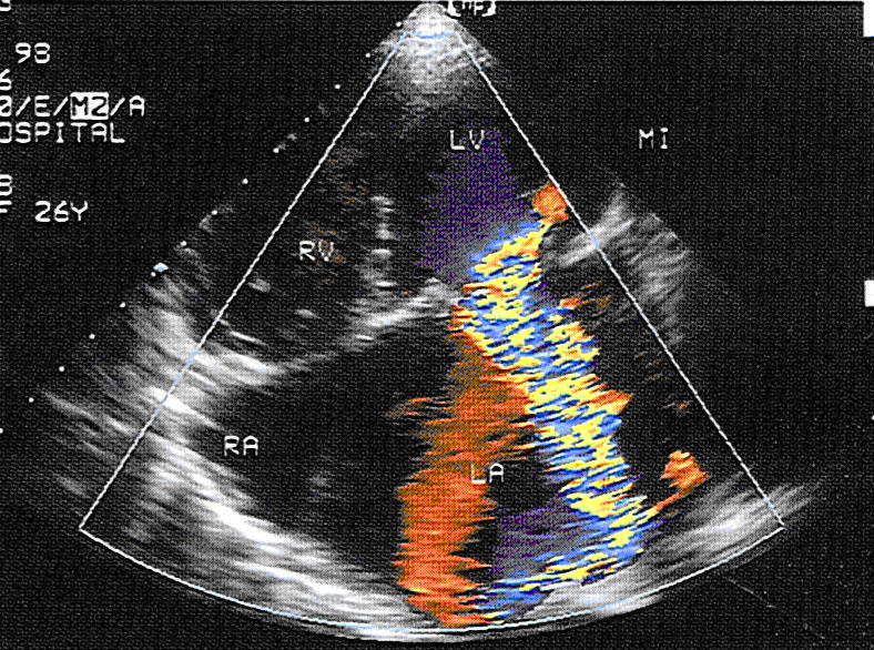 超声检查如图,该病例二尖瓣反流面积与左心房面积之比为37%,提示反流