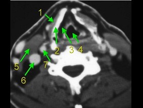 9.下面是一颈部ct图,其中结构标志不正确的是