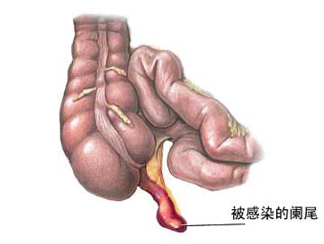 孕妇阑尾炎的位置图片图片