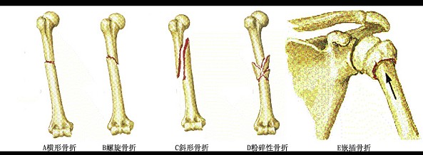 膜內化骨快於軟骨內化骨,內骨痂快於外骨痂b