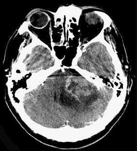 18.听神经瘤(如图所示)的最常见症状为